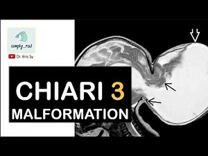 Chiari 3 malformation (MRI)