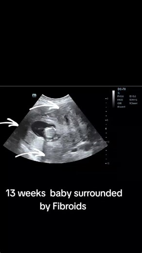 Understanding Uterine Fibroids During Pregnancy