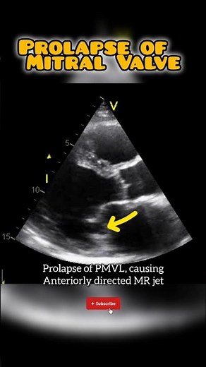 Mitral Valve Prolapse on Echocardiography #echo #cardio