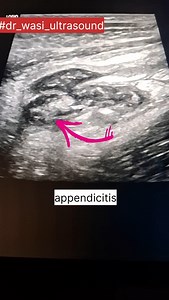 6.2K views · 1.3K reactions | Appendicitis #perforatedappendix #dr_wasi_ultrasound #ultrasonography #radiologist #neetpg #ultrasonografia #ultrasoundmadeeasy #abdominalultrasound #medicaleducation #docotor | Ultrasound made easy | Facebook