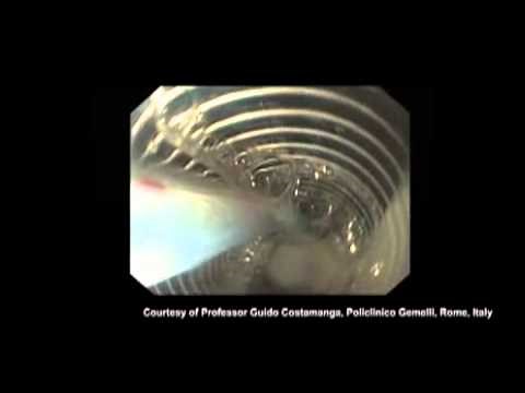 Esophageal Stent Removal using GUARDUS™ Overtube | STERIS