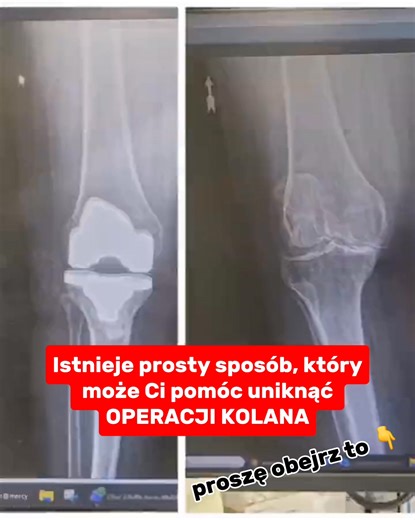❌ Ból kolan NIE MUSI być częścią Twojego życia ❌ Ta orteza zmieniła życie tysięcy Polaków: ✅ Technologia Stabilizacji Rzepki 360° ✅ Ulga już pierwszego dnia ✅ Po tygodniu: 50% mniej bólu ✅ Nie zsuwa się - trzyma cały dzień! 🎯 TYLKO TERAZ ZNIŻKA AŻ -50%! 🎯 ⬇️ KUP TERAZ - Przynieś ulgę swoim kolanom ⬇️ | Naturlex.pl