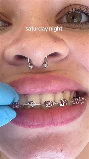 Alegria da remoção do aparelho e uma vida inteira de contenção ortodôntica 😅❤️🦷✨ #ortodontia #aparelho #aparelhoortodontico #contencao #dentista
