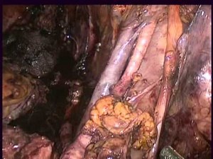 Lymphadenectomy After Radical Cystectomy - A New Access • Video • MEDtube.net