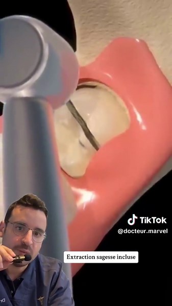 Conseils post-opératoires après extraction dentaire