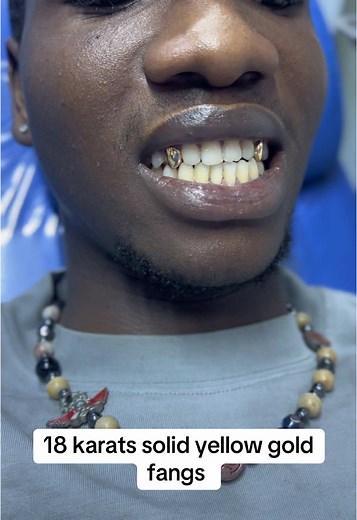 Custom 18 Karat Gold Grillz for Stylish Expression