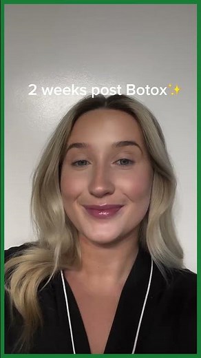 Botox Before and After: 2-Week Transformation ⏱️ #shorts #Botoxbeforeandafter #Botoxresults