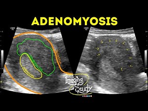 Adenomyosis || Ultrasound || Case 42