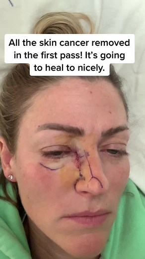Basal Cell Carcinoma Surgery Success Story