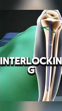 Tibia lengthening surgery