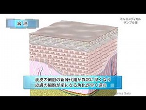 Psoriasis Vulgaris / Medical Video Dictionary in 2 Minutes - MilMedical