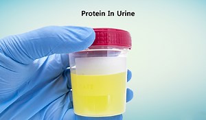 Natural Treatment for Proteinuria in Ayurveda - Planet Ayurveda