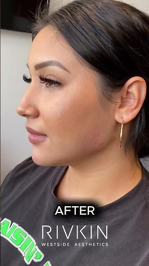 See How We Snatched Her Chin + Jawline with Fillers 💉