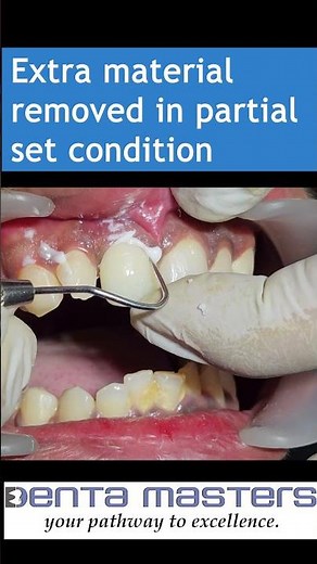 Cementation of Layered ZIRCONIA crown with GIC | step by step | shorts