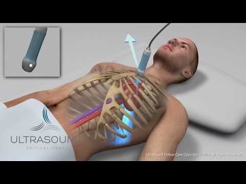 How to obtain: Parasternal Long Axis Ultrasound View - Training and Techniques - ICU