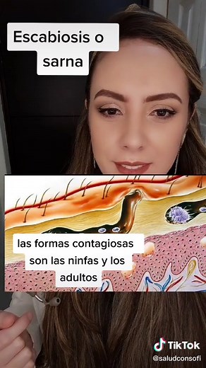 ¿Qué es la escabiosis? Síntomas y tratamientos efectivos