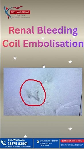 "Kidney Bleeding Treatment Explained: Coil Embolisation Procedure | Safe & Minimally Invasive"