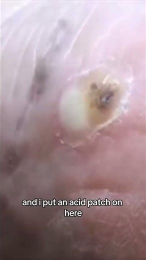 Freezing vs. Acid for Warts - What Happens When Treatment Spreads?