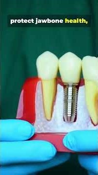 🦷 Implants vs Partials — What’s the Real Cost?