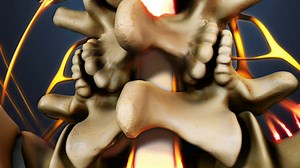 Failed Lumbar Decompression Back Surgery