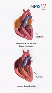 697 reactions · 161 shares | ⚠️ Ventricular tachycardia (VT) is a...