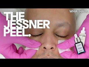 THE JESSNER PEEL | Is It Worth It? Detailed Before & After