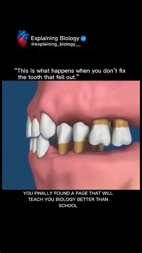 Explaining Biology on Instagram: "🦷✨ This is what happens when you don’t fix a missing tooth. When a tooth falls out, the empty space doesn’t stay empty for long… The neighboring teeth slowly begin to tilt, shift, and collapse into the gap. Over time, this can lead to: 🔹 Crooked or crowded teeth 🔹 Difficulty chewing 🔹 Shrinking of the jawbone 🔹 Bigger gaps forming 🔹 Complete bite misalignment Your teeth work like a team — lose one, and the entire system starts falling apart. Take care of y