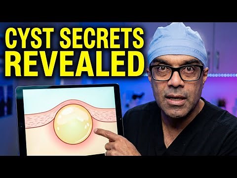 What is a Sebaceous Cyst | Benign Lumps You Don't Need to Fear