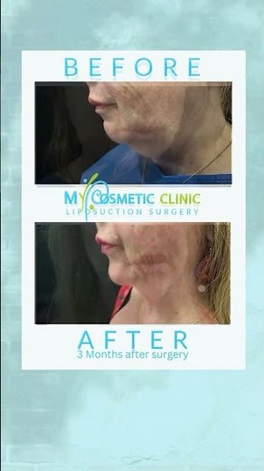 Chin liposuction before and after photos My Cosmetic Clinic