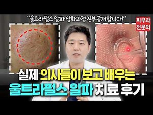 실제 피부과 의사들이 보고 배우는 닥터라이언 여드름 흉터치료법! 울트라펄스 알파 심화과정 강의자료 공개합니다!