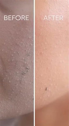 ASMR Tool Deep Clean 😳⚡ |Instant Face Transformation!