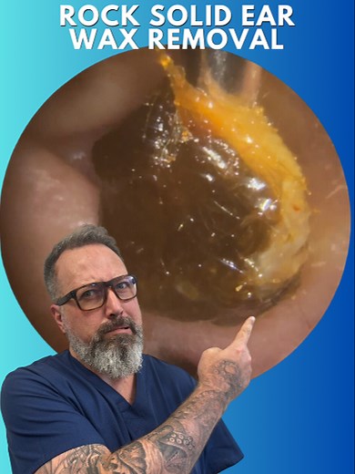 Rock Solid Ear Wax Removal - Bilateral Both Ears | Ear Wax Cleaning Video