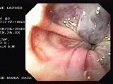Acute Variceal Bleeding - Large Varices with Red Sign • Video • MEDtube.net