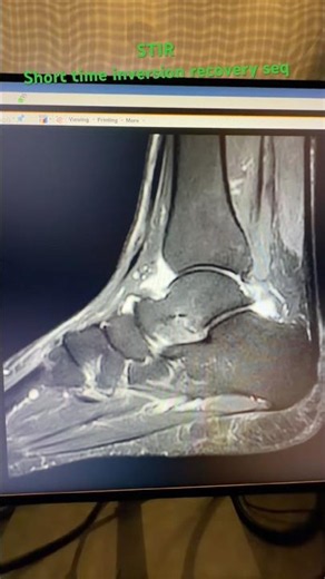 #mri # mri ankle sequence # mri scan