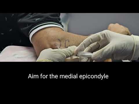 Elbow Joint (Ulnohumeral Joint) Steroid Injection| Dr Pradeep Bala