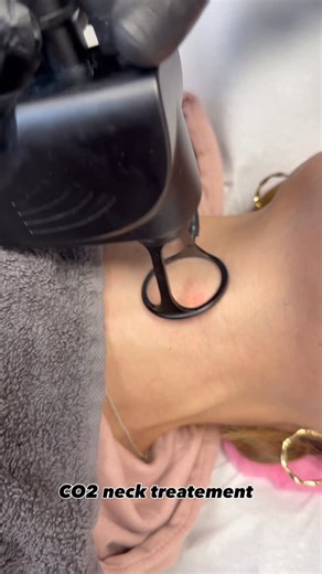 Z Laser on Instagram: "#co2 #skin #laser #co2laser #co2fracionadorj"