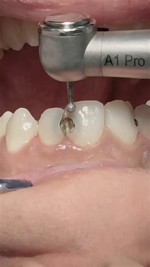 front tooth smile correction with root canal treatment #arogyam #dentalcare #dentalclinic