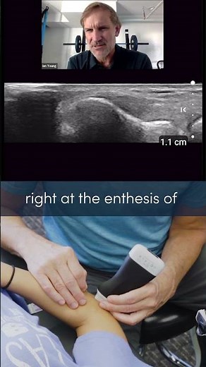 Watch Dr. Young demonstrate the precision of ultrasound-guided dry needling on the lateral elbow!
