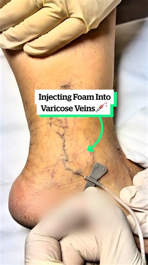 1.6M views · 1.4K reactions | Injecting Foam Into Varicose Veins  | VT | Facebook