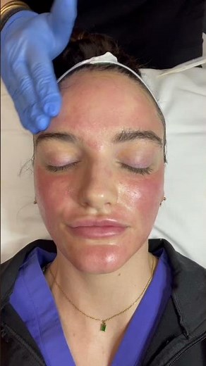 SkinPen Microneedling Before and After #skinpen #microneedling #aesthetics #skincare #prp #plated