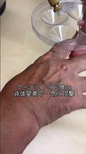イボ12個を一気に治療！液体窒素療法 |