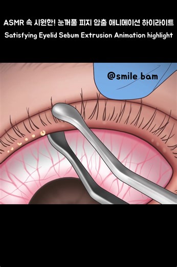 ASMR 속 시원한! 눈꺼풀 피지 압출 애니메이션 하이라이트 Satisfying Eyelid Sebum Extrusion Animation Highlights #ASMR #fyp #추천 #SOONENT #treatment #care #animation