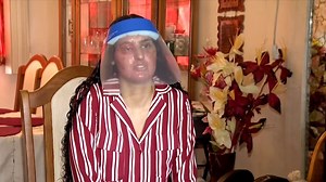 Acid attack victim speaks after horrifying incident