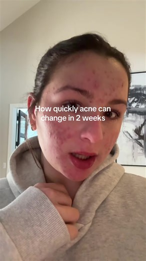 #acne #accutane #fyp | Accutane