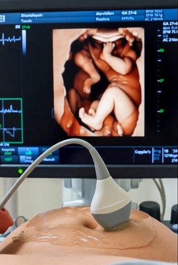 🔬 Triplet Monitoring: Advanced Doppler Vision #Shorts #Viral #Triplets #Triplettes #Ultrasound4D