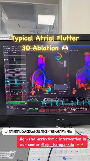dr. Muhamad Fajri Adda'i | @pjn_harapankita Typical Atrial Flutter 3D Ablation! This was a cavotricuspid isthmus ablation using 3D mapping. The colorful signals... | Instagram