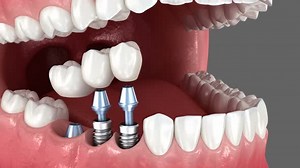 Detailed 3D Animation of Dental Implant Installation Process