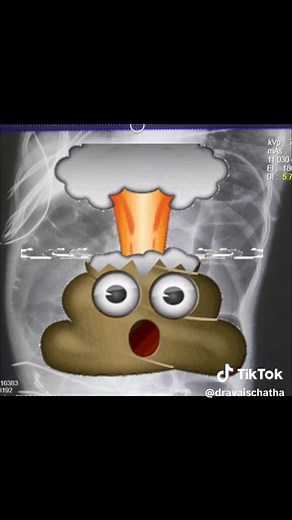 Ogilvie’s syndrome or acute colonic pseudo-obstruction is a syndrome that causes marked abdominal distension without evidence of mechanical obstruction. #olgiviesyndrome —>This is an emergency and can lead to an exploding colon —>Treated initially by emergent decompression #colonoscopy —>Usually happens is very sick patients usually in the ICU for other issues. —>This patient did great! #Gastroenterologist #GI #Doctor #Gidoctor #Gastroenterology #Healthcare #Coloncancer #Coloncancerscreening #Sc