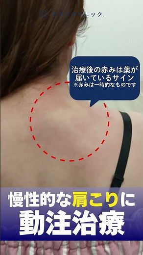 慢性的な肩こりに動注治療 外来時にすぐできる！