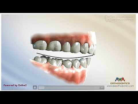 ep18. | levelling Curve of spee and deep bite correction | Part 1